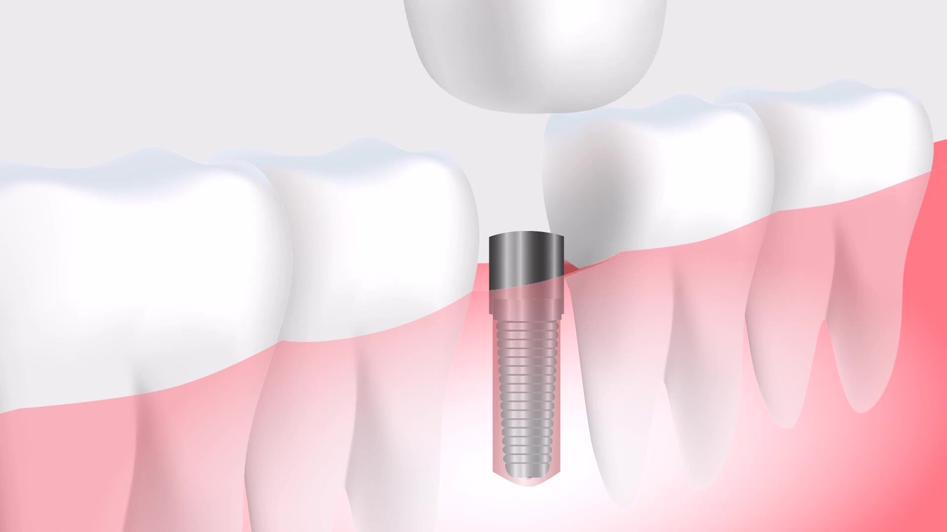 Animation of a dental implant placement